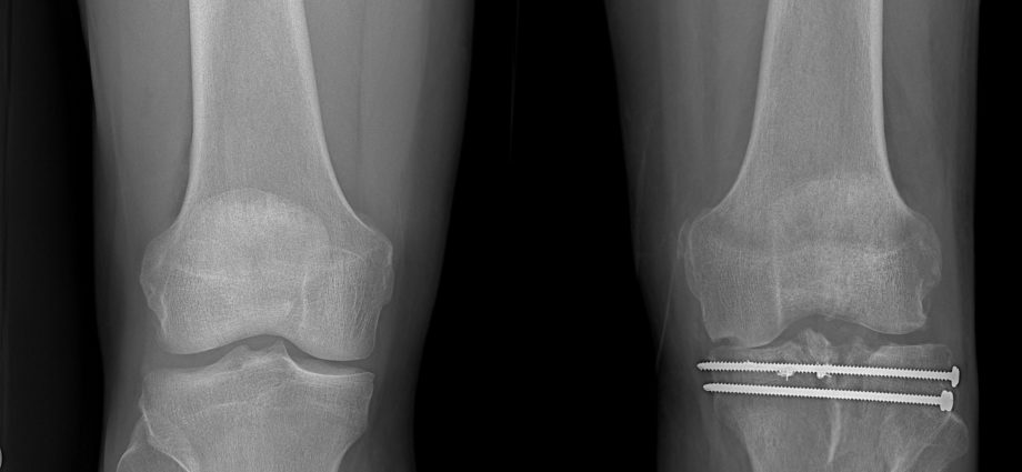 knee xray